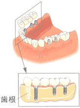 取り外し入れ歯とインプラントの比較